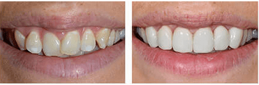 Cosmetic Dentistry from Perfect Smile
