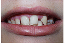 Before Tooth Decay Treatment from Perfect Smile