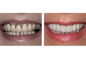 Fast-Fixed Smile Makeover - The Perfect Smile