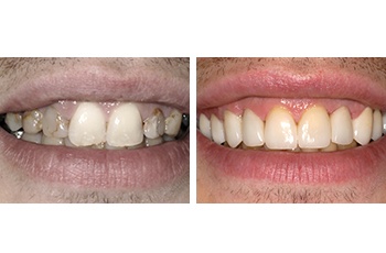 Tooth Decay Treatment Before and After by Perfect Smile 2017