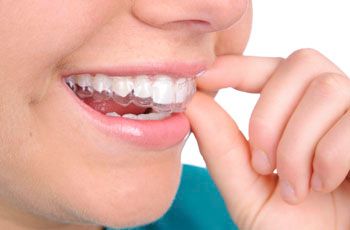 Clear Aligners - The Perfect Smile