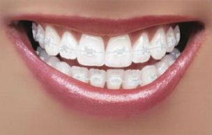 teeth-braces