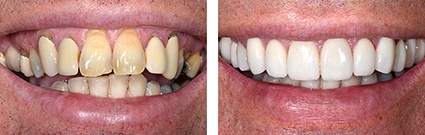Smile Makeover replacement crowns