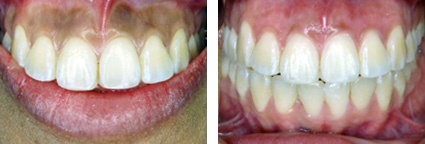 Gum Whitening Treatment from Perfect Smile