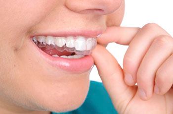 how does invisalign work?