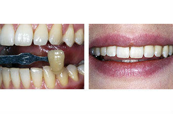 Teeth Whitening Solutions- The Perfect Smile