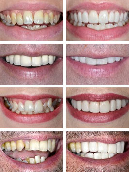 Before-After Dental Crowns