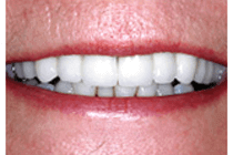 After Smile makeover - The Perfect Smile