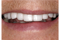 After Smile makeover - The Perfect Smile
