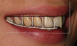 Dental Smile Designing Step 2