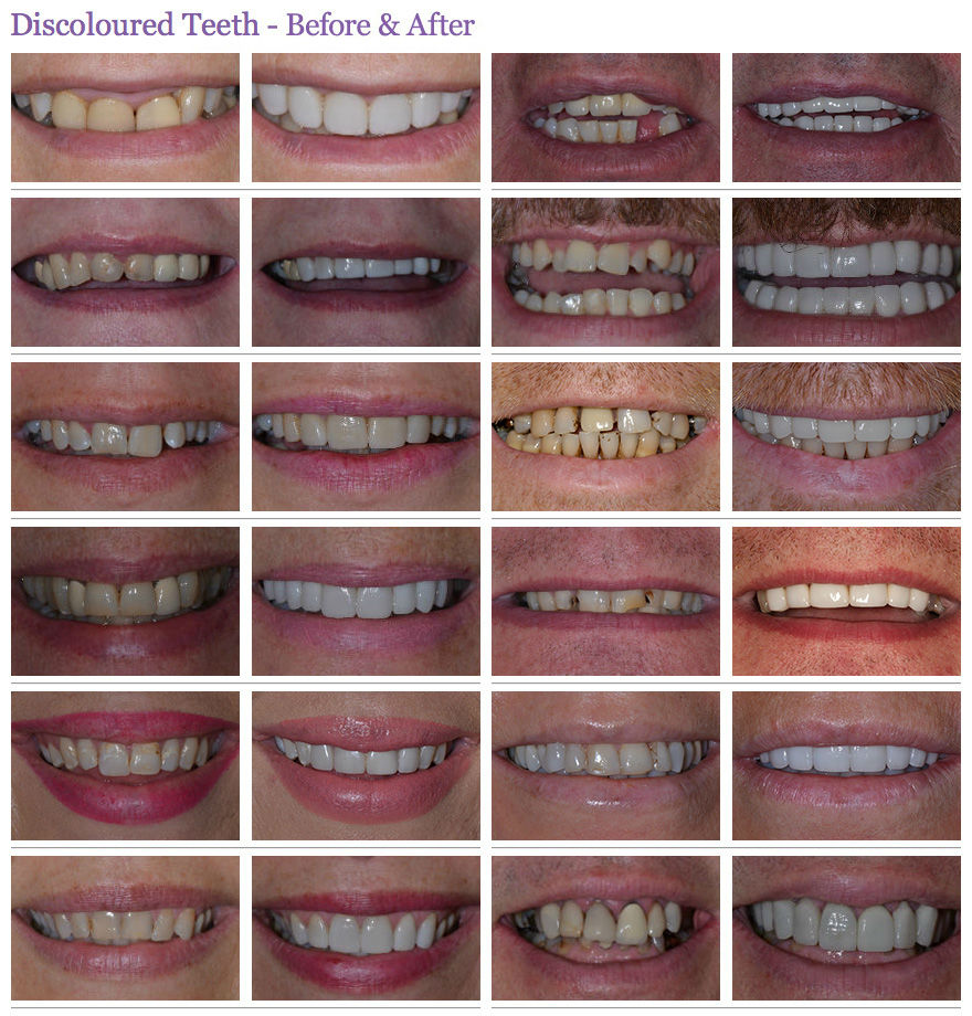 discoloured teeth before and after case 3