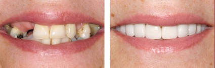 Treatment for Missing Teeth by Perfect Smile