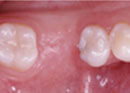 Step 7 - Replacing missing teeth for improved function and aesthetics