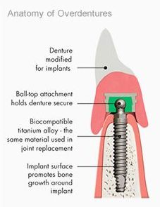 Denture Stabilisation - Anatomy of Overdentures