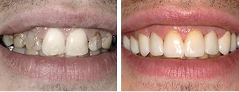 Treatment For Decayed Teeth by Perfect Smile