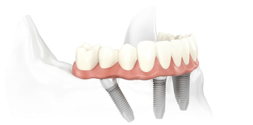 Dental Implants from Perfect Smile Cosmetic Dentist