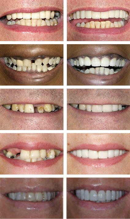 Gaps in Teeth Smiles
