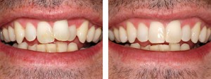Cosmetic dentistry before and after