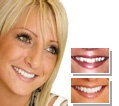 Ideal Perfect Smile Makeover