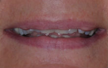 JANE G CROOKED TEETH / CROWDING BEFORE PHOTOS TPS LONDON, DISCOLOURED TEETH BEFORE PHOTOS
