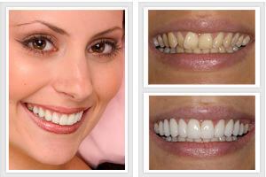 Before & After having cosmetic dentistry at Perfect Smile Studios