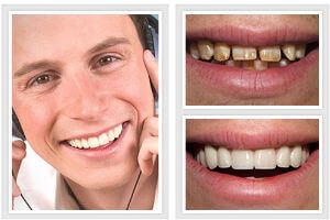 Before and After Perfect Smile Cosmetic Dentistry