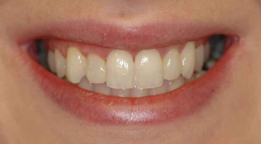 Cfast | Cosmetic Tooth Alignment | The Perfect Smile Studios