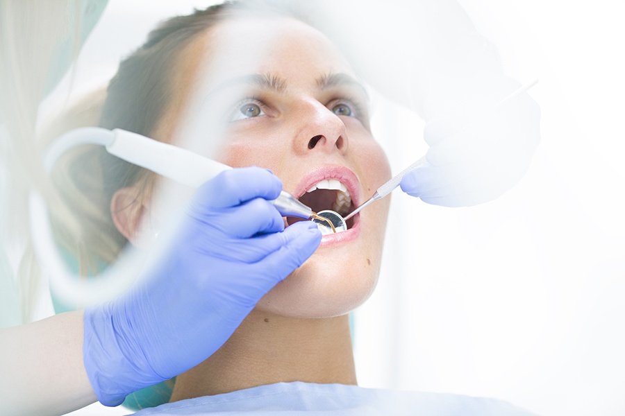 How are veneers bonded to teeth?