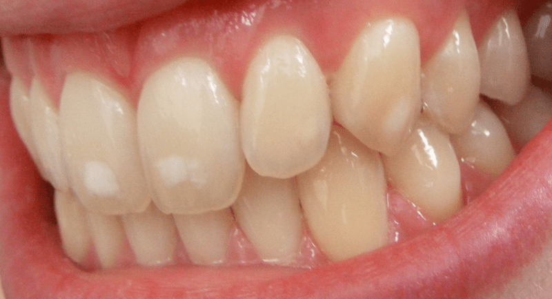 Fluorosis treatment at The Perfect Smile