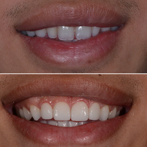 Dr Sam Jetwa's Before and After Dental treatment Case 16
