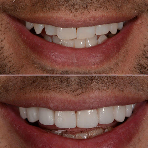 Dr Sam Jetwa's Before and After Dental treatment Case 31