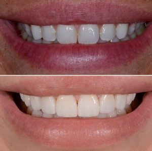 veneer before and after