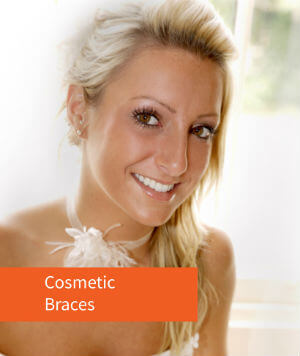 Cosmetic Braces