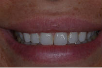CHARITY P WORN TEETH - AFTER PHOTOS