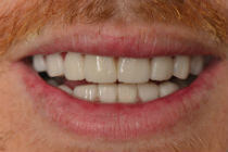 CHRIS M CROOKED TEETH / CROWDING AFTER PHOTOS