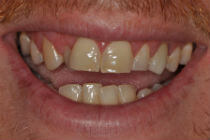 CHRIS M CROOKED TEETH / CROWDING BEFORE PHOTOS