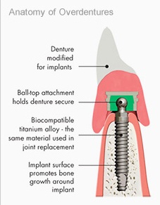 how do implants work
