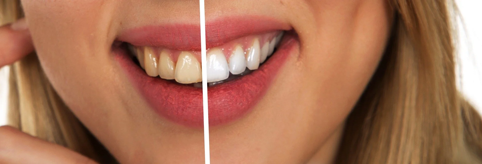 Yellow teeth: how to avoid