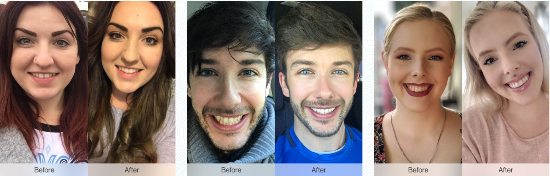 invisalign before and afters
