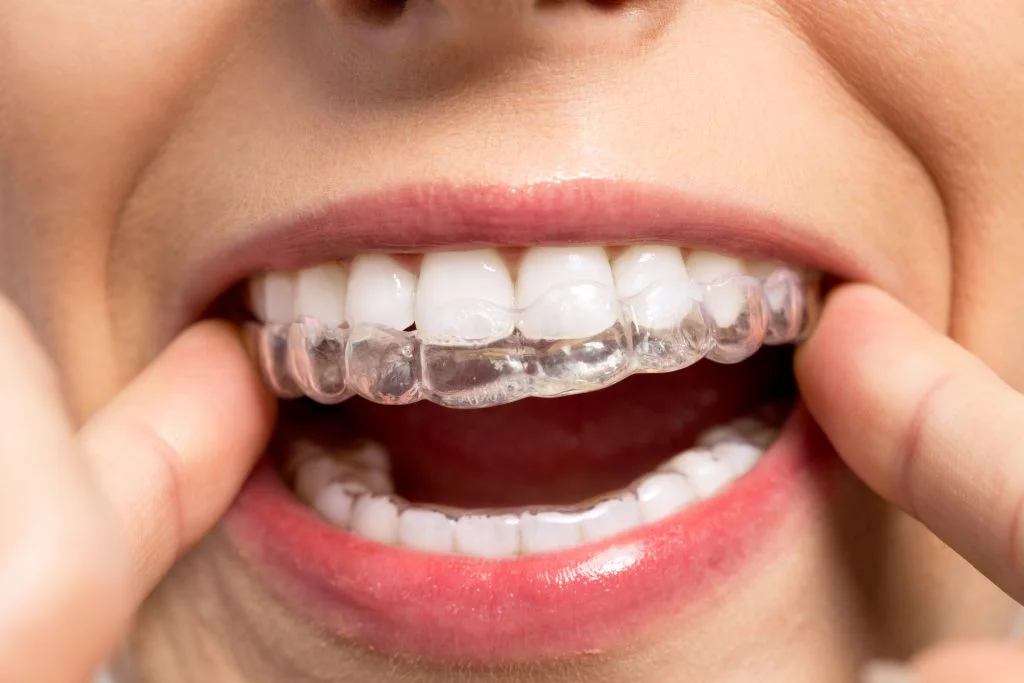 Invisalign tips that will blow your mind