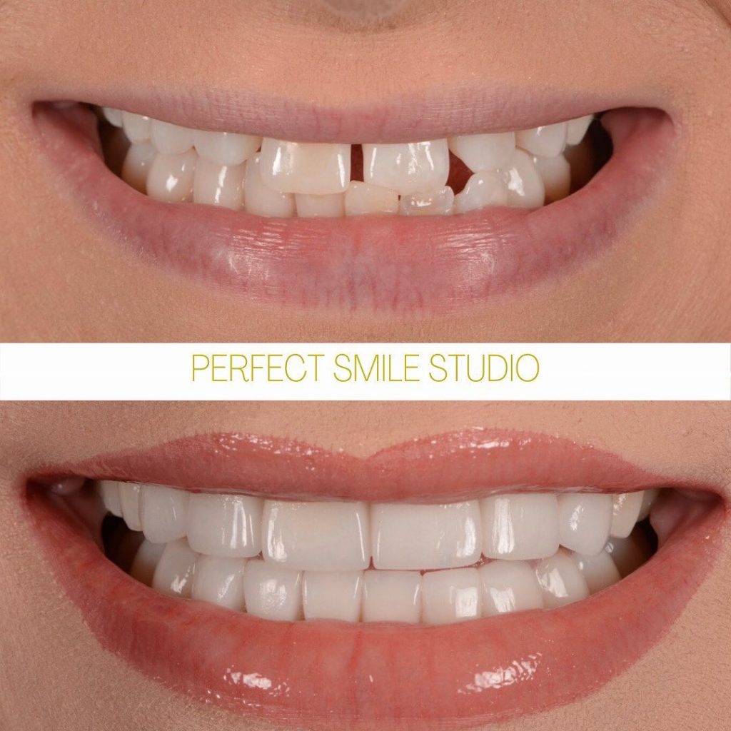 before-and-after-veneers