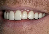 David Worn Teeth After