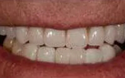 dental-bridges-after