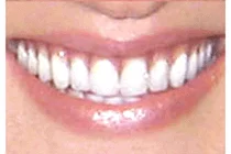 Helen Dental Implants After