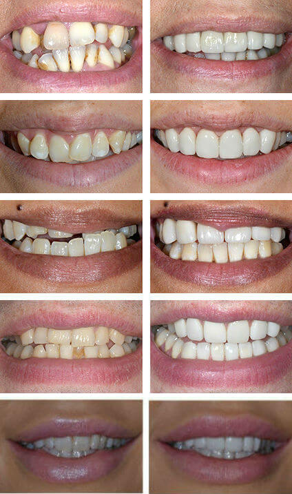 Veneers Used to Correct Crooked Teeth