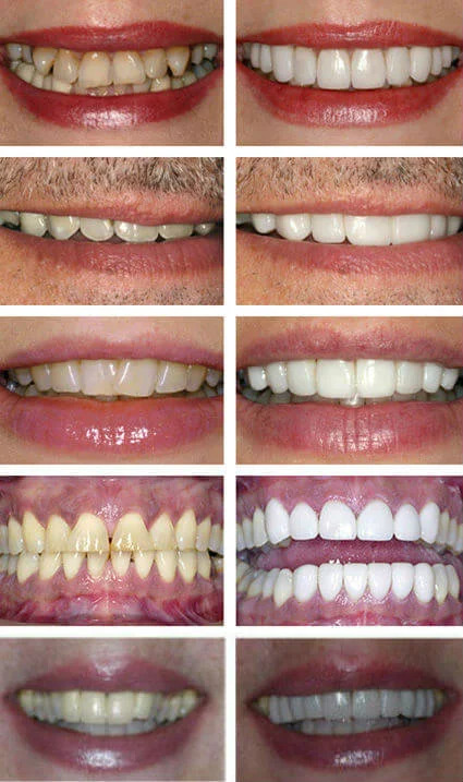 Veneers to Cover Stained or Discoloured Teeth