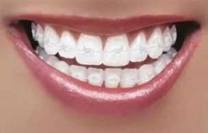 other popular braces