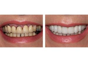 Cosmetic Dentistry Nearby Enhance Your Smile Close to Home