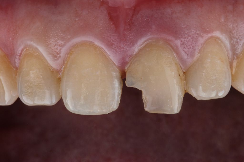 chipped and worn teeth