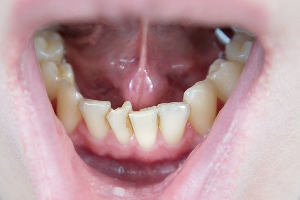photo of crooked teeth